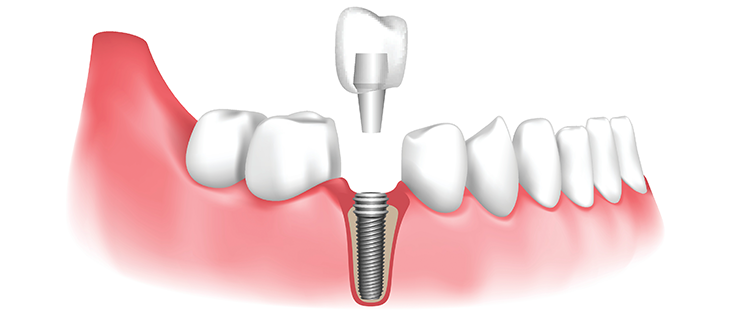 Affordable Dental Implants Vista