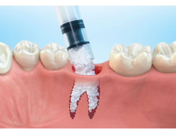 Bone Grafting Vista