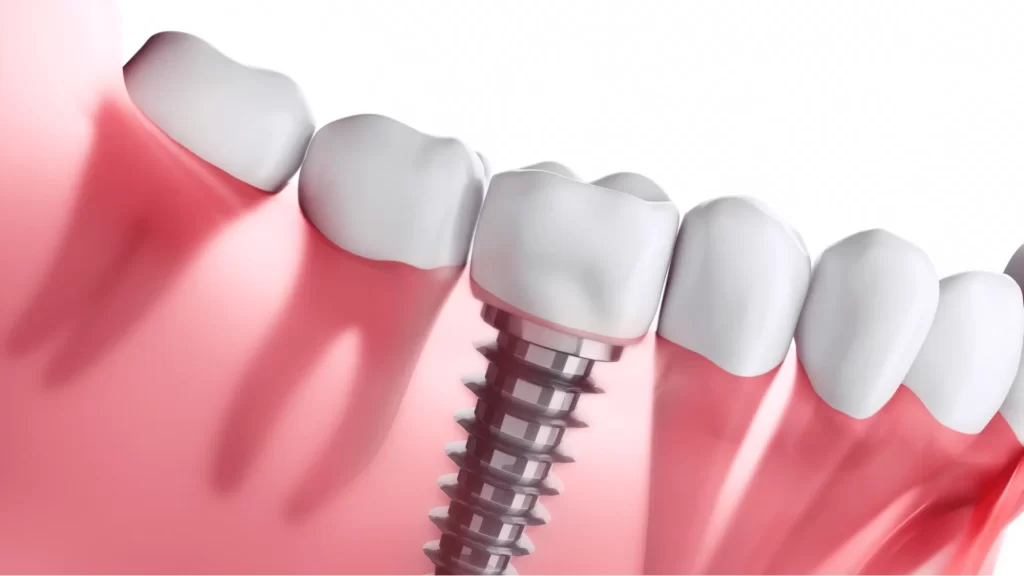 Dental Implant Cost Carlsbad
