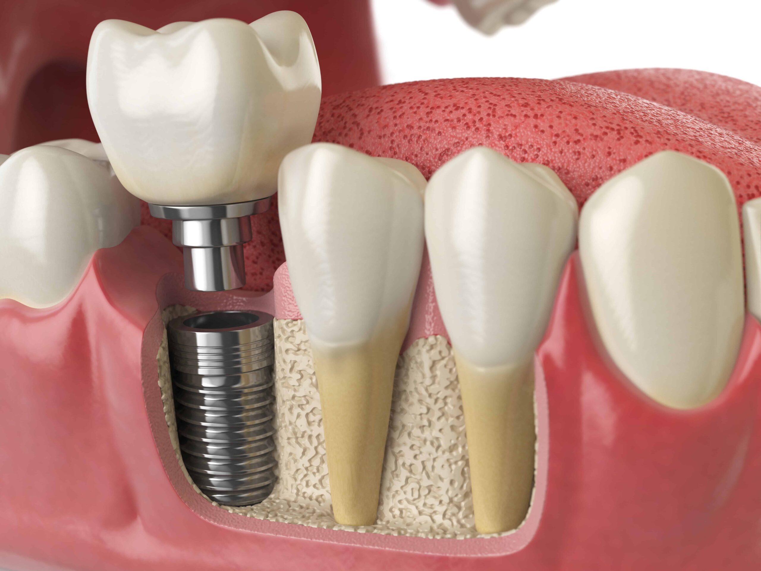 Dental Implant Cost Oceanside