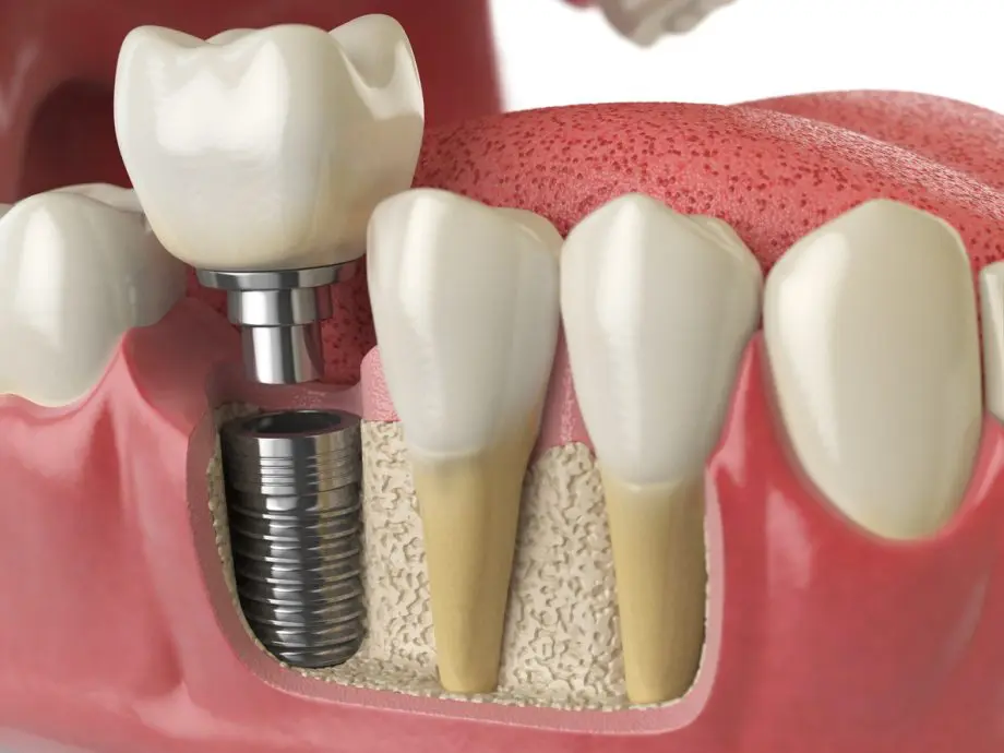 Dental Implants Procedure Oceanside