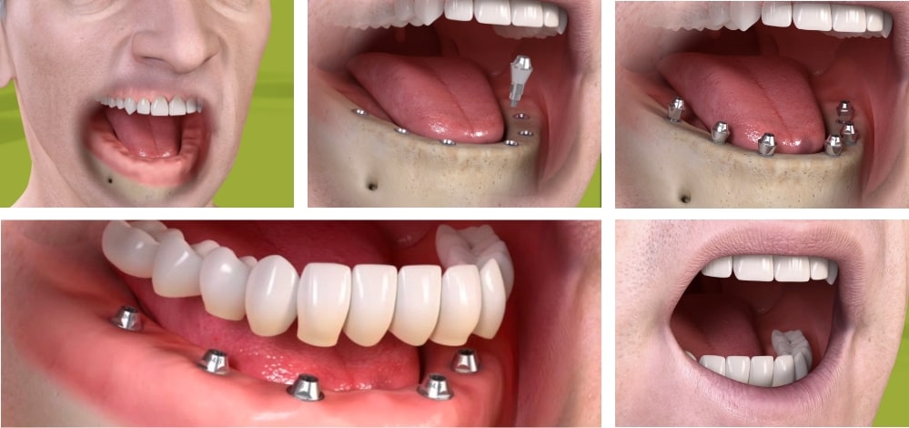 Full Mouth Dental Implants Encinitas