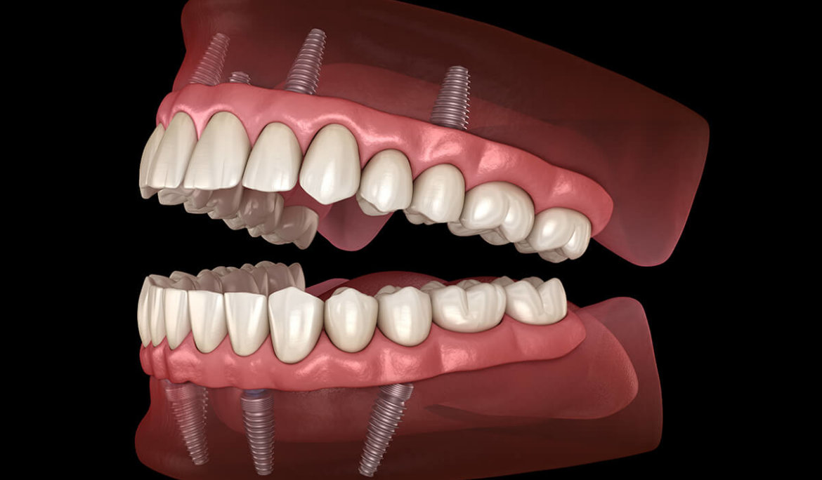 Full Mouth Reconstruction Dental Implants Carlsbad