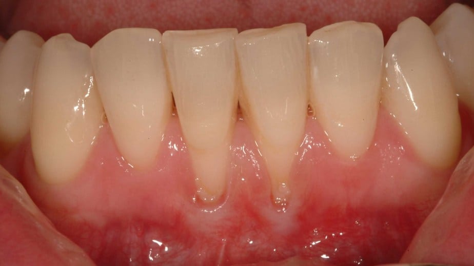 Gum Disease And Receding Gums Encinitas