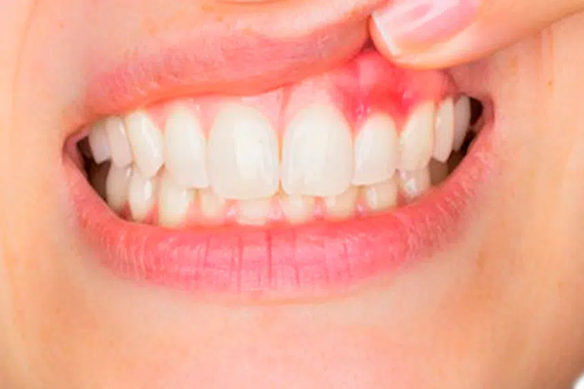 Gum Disease Symptoms Carlsbad