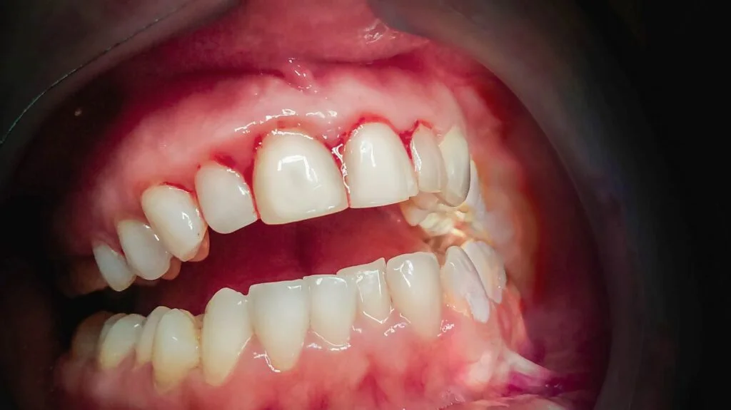 Gum Infection Symptoms Vista
