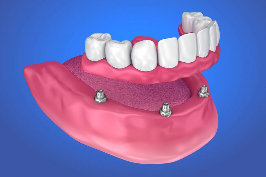 Implant Supported Dentures Vista