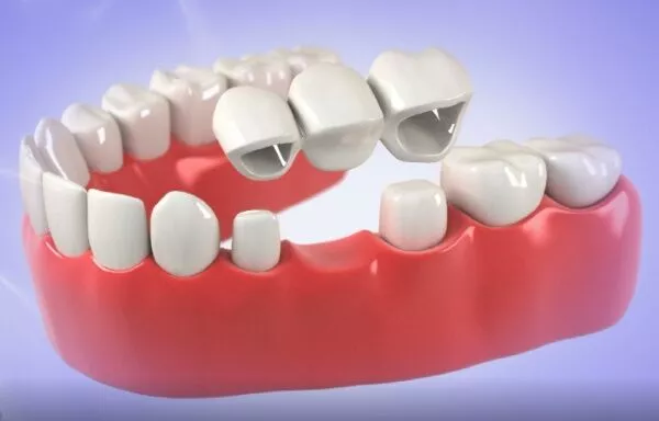 Implant Tooth Bridge Vista