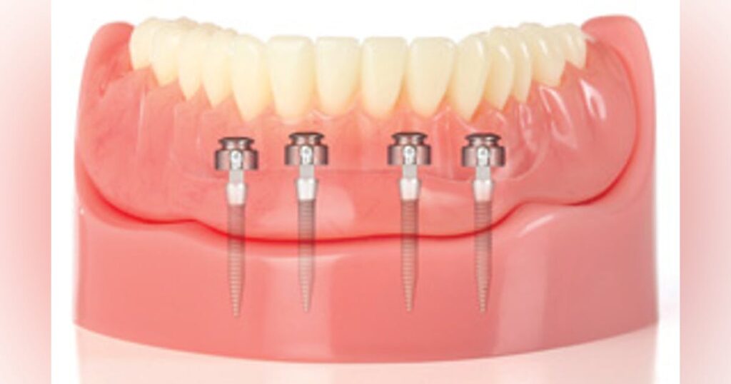 Mini Dental Implants Encinitas