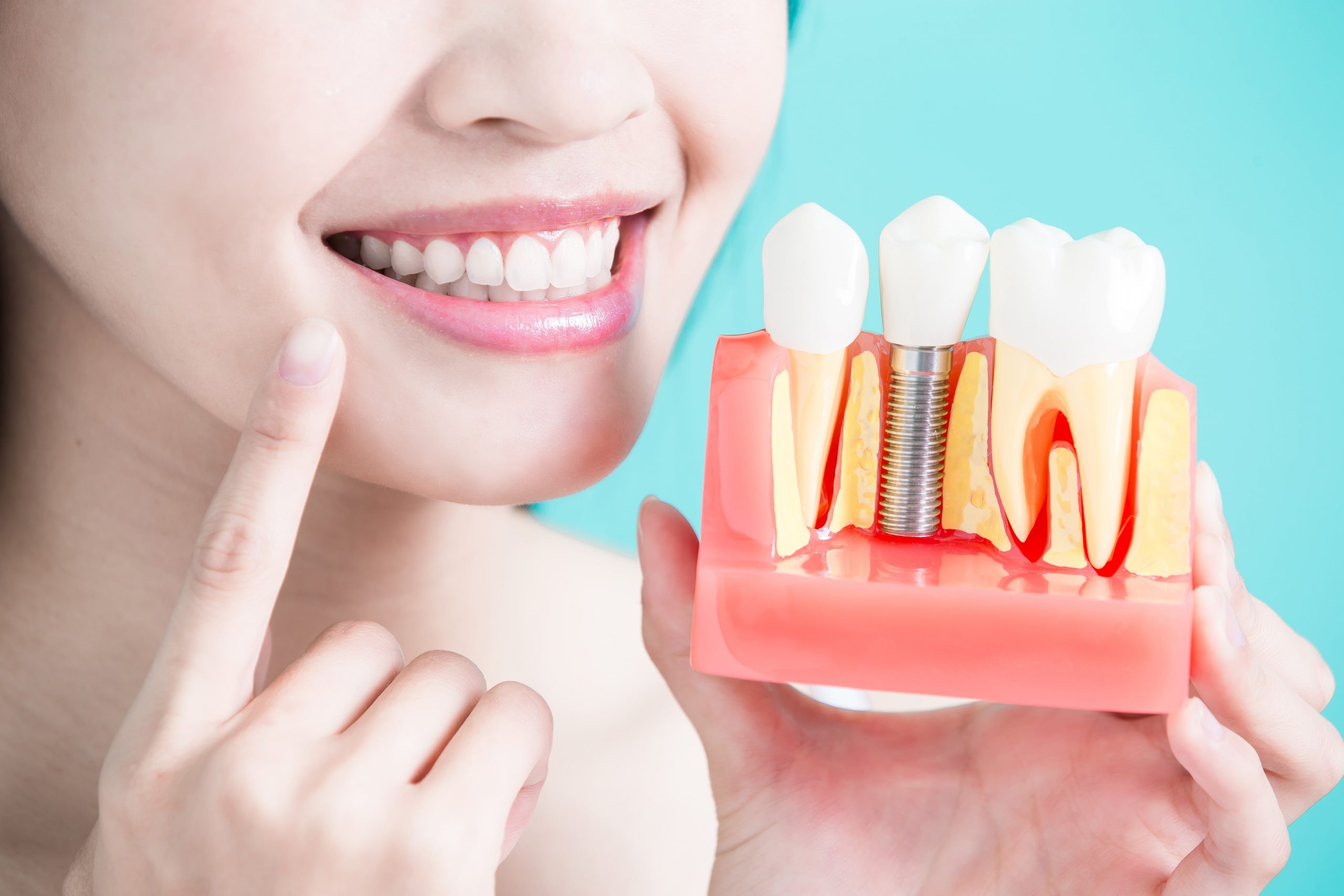 Affordable Dental Implants Encinitas