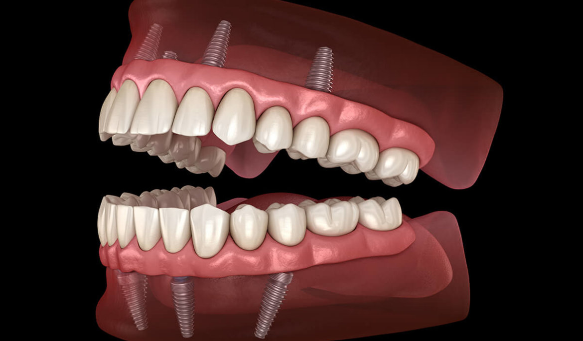 All On X Dental Implants Carlsbad