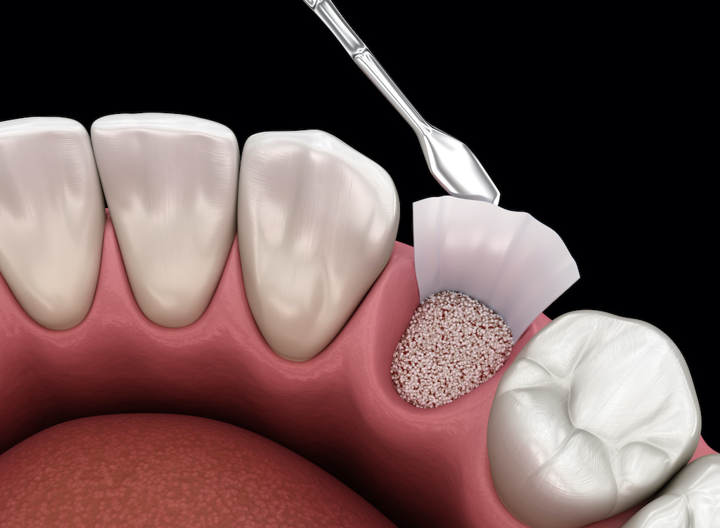 Bone Grafting Encinitas