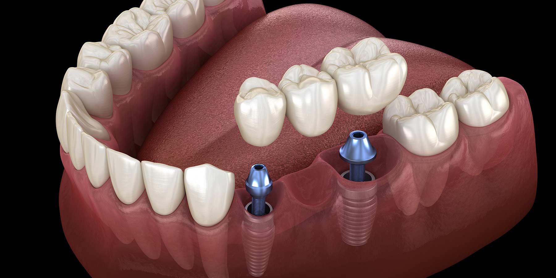 Dental Implant Bridge Oceanside