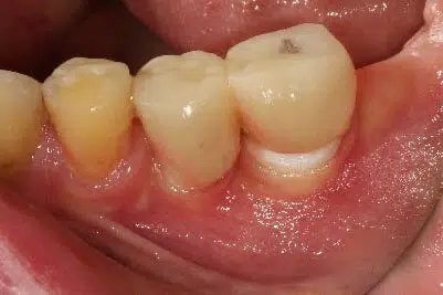 Dental Implant Infection Encinitas