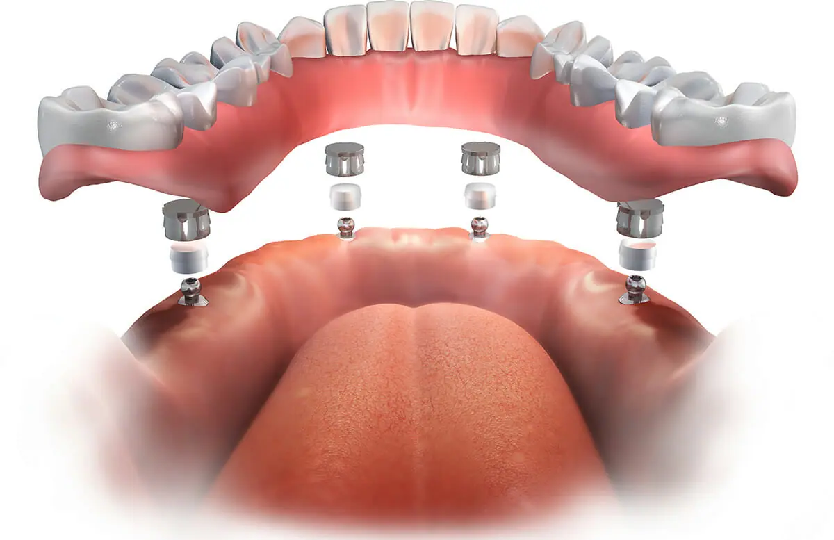 Denture Dental Implants Vista