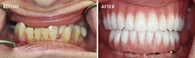 Full Mouth Reconstruction Dental Implants Oceanside