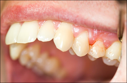 Gingivitis Treatment Carlsbad