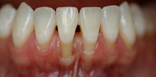 Gum Disease And Receding Gums Carlsbad