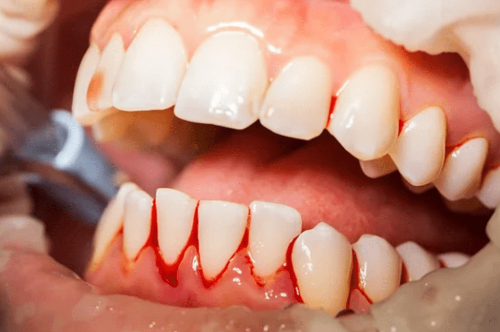 Gum Disease Symptoms Oceanside