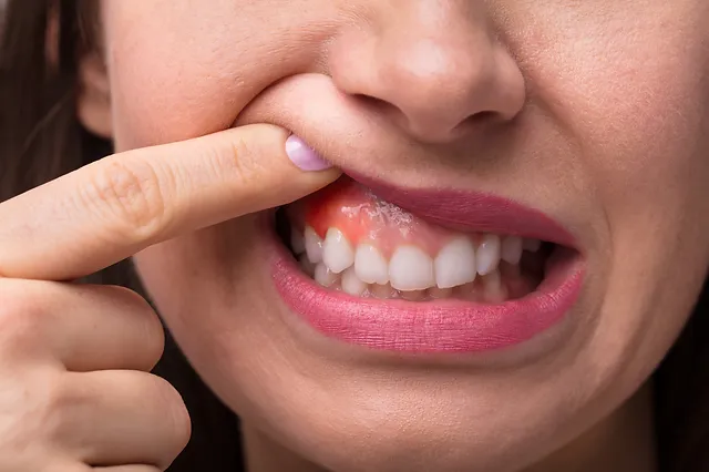 Gum Infection Symptoms Encinitas
