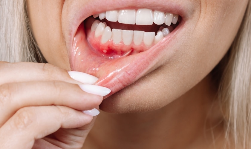 Gum Inflammation Treatment Oceanside