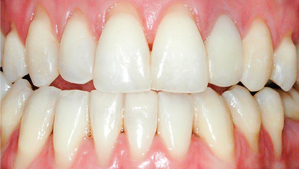 Gum Recession Treatment Carlsbad