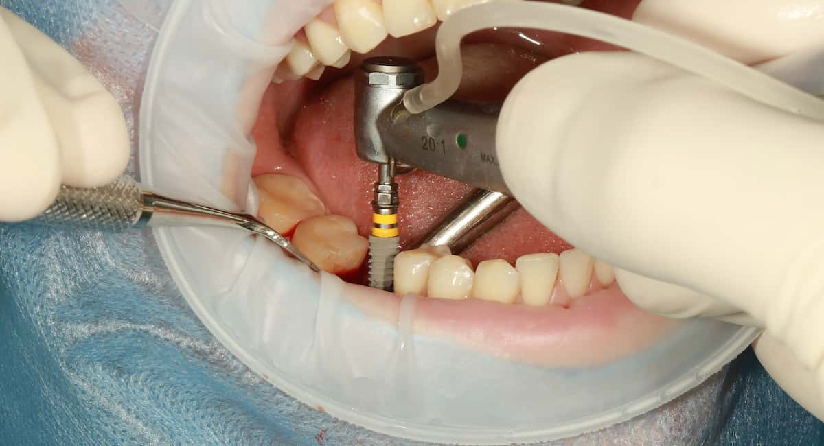 Implant Dentistry Surgery Oceanside