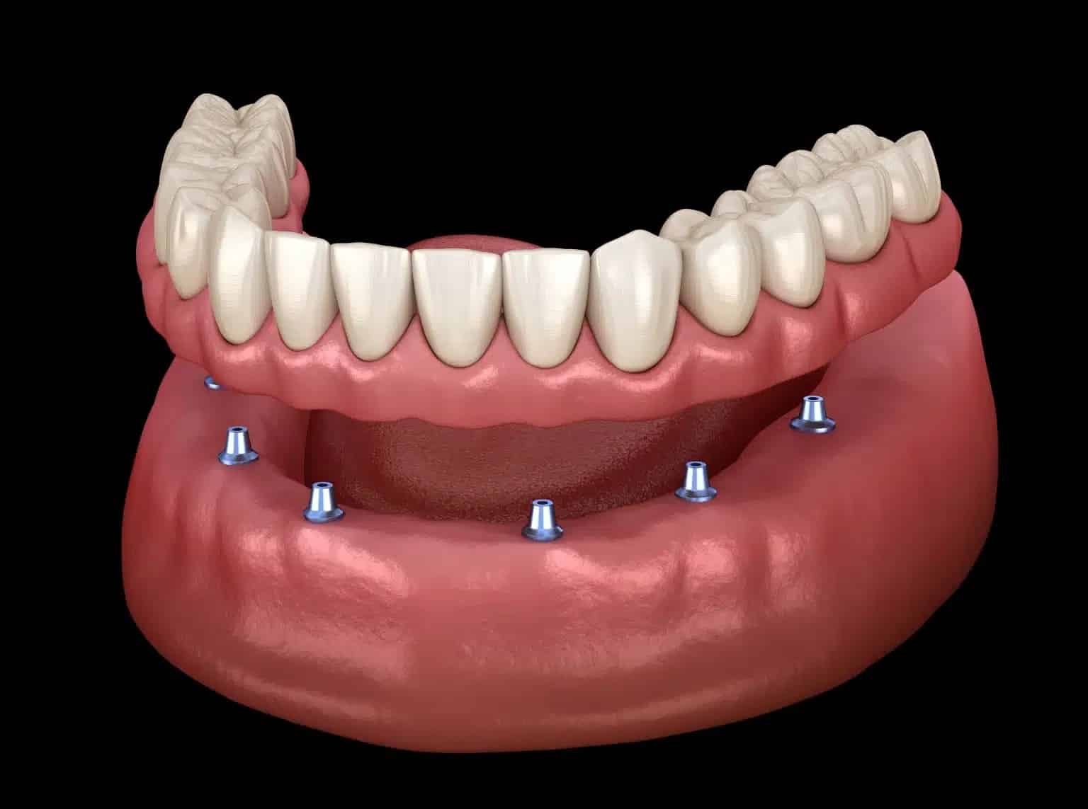 Implant Supported Dentures Encinitas