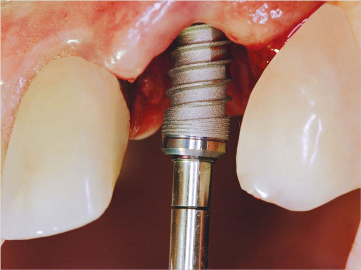 Implant Teeth Procedure Encinitas