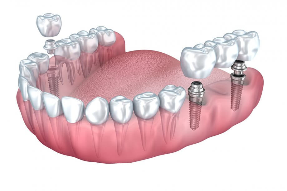 Implant Tooth Bridge Vista