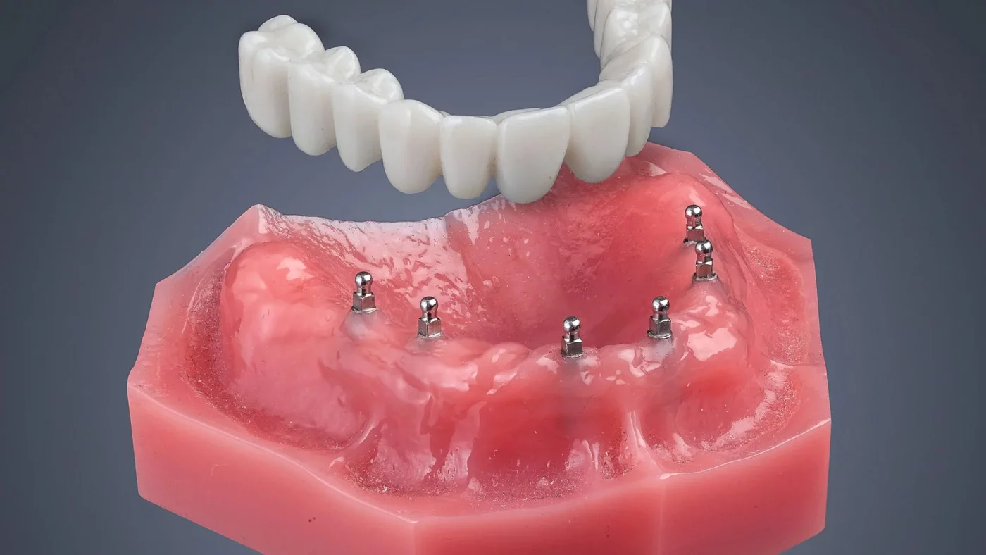 Mini Dental Implants Carlsbad