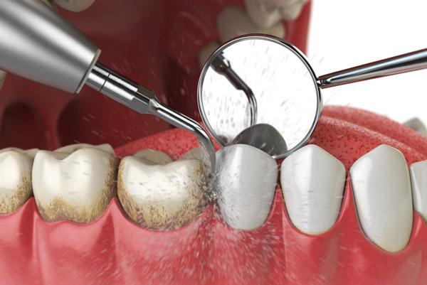 Periodontal Cleaning Encinitas