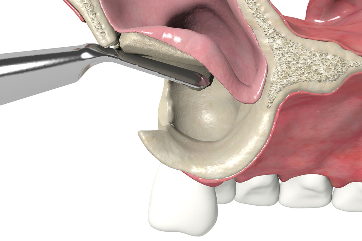 Sinus Lift Carlsbad