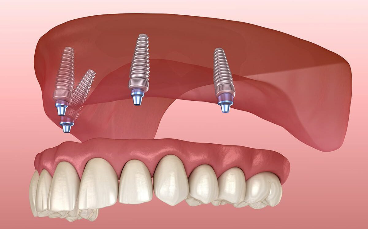 All On 4 Dental Implants Vista