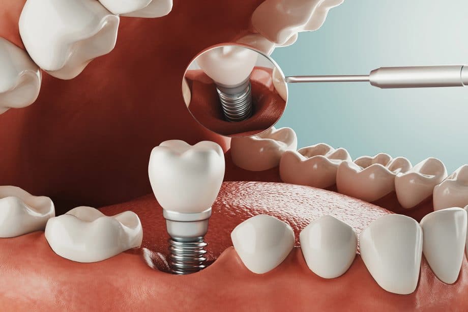 Dental Implants Procedure Encinitas