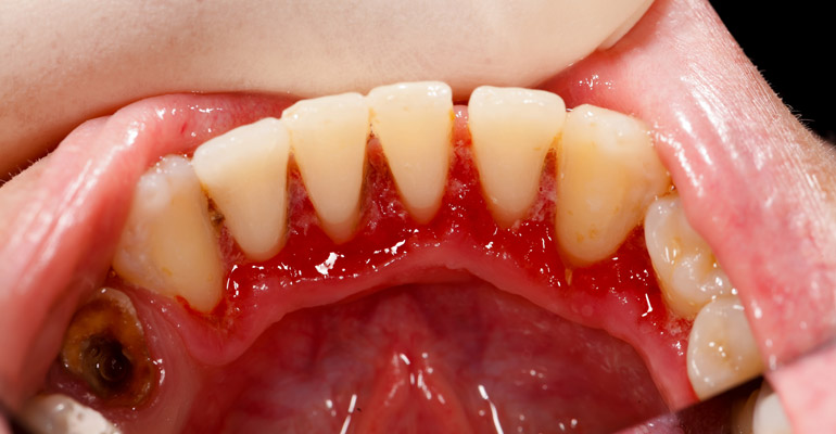 Gum Disease Symptoms Vista