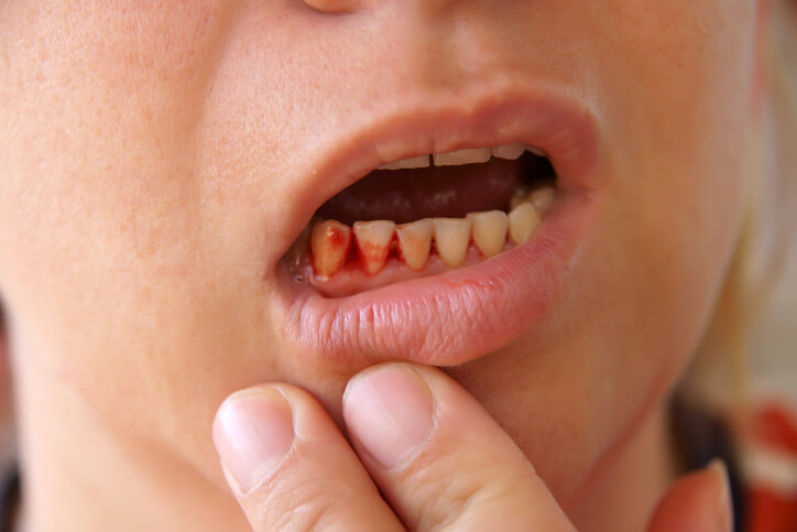 Gum Infection Symptoms Carlsbad