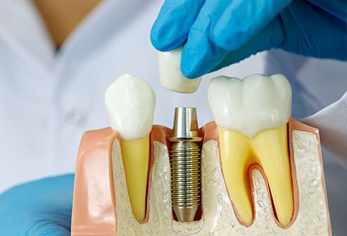 Implant Dentist Near Me Carlsbad