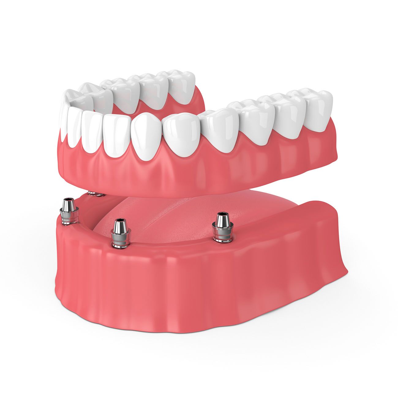 Implant Supported Dentures Carlsbad