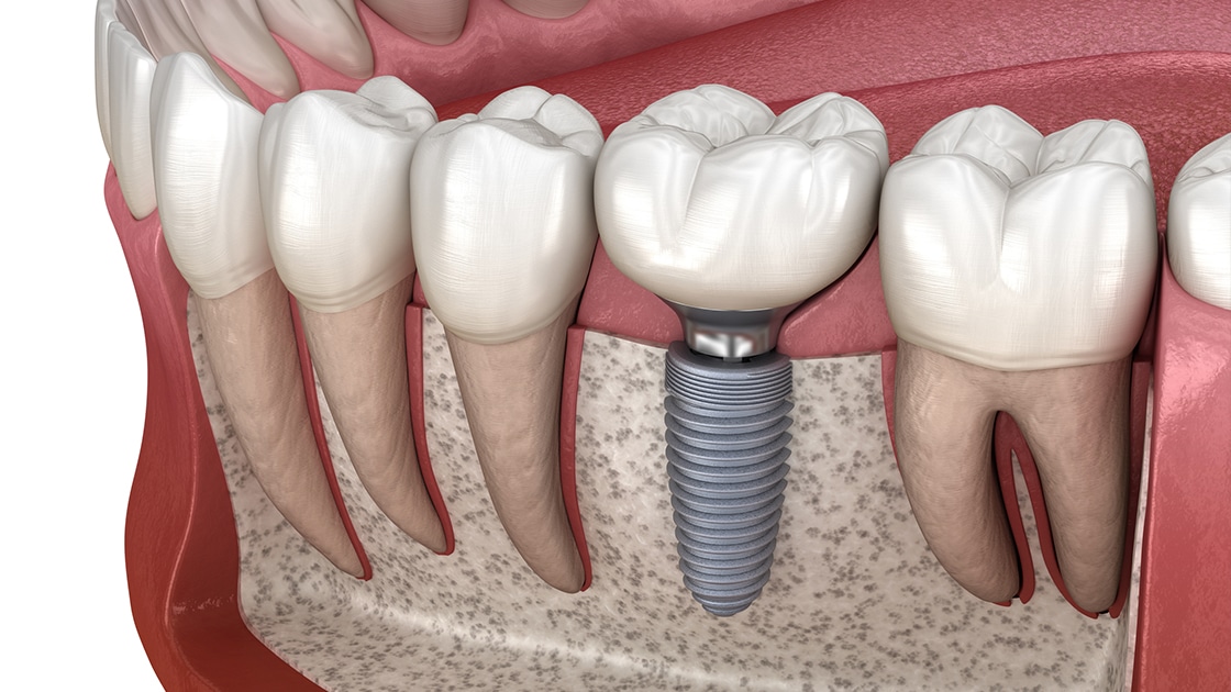 Implant Teeth Procedure Carlsbad