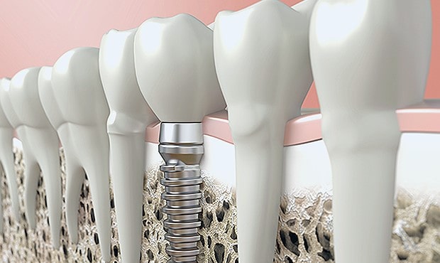 Implant Teeth Surgery Encinitas