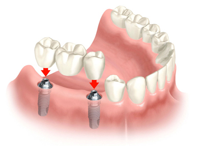 Implant Tooth Bridge Encinitas