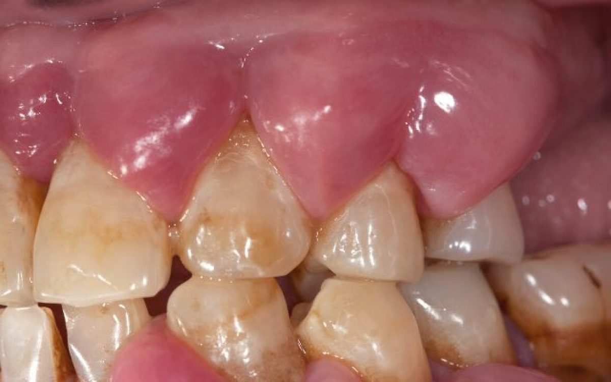 Periodontal Abscess Vista