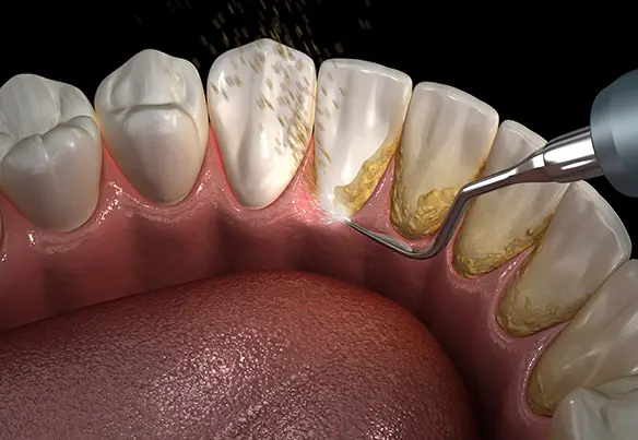 Periodontal Maintenance Vista