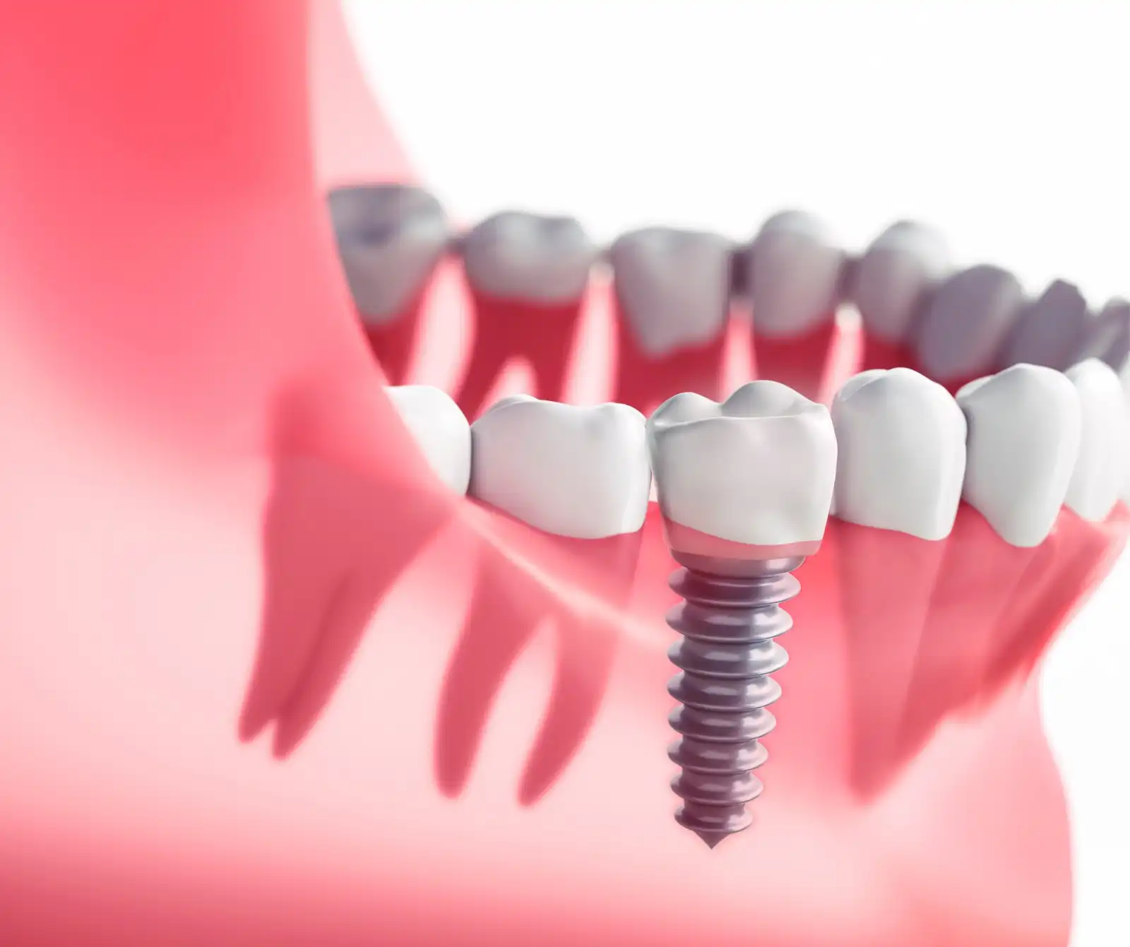 Affordable Dental Implants Oceanside