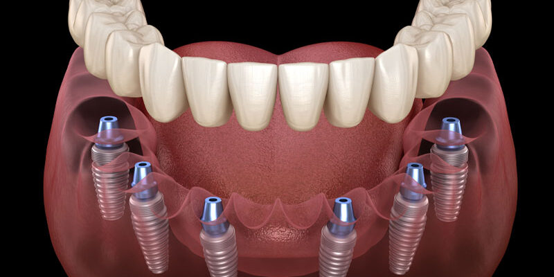 Full Mouth Dental Implants Vista