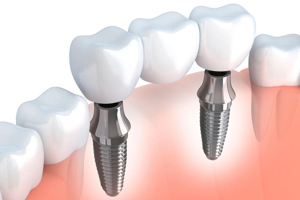 Implant Tooth Bridge Carlsbad