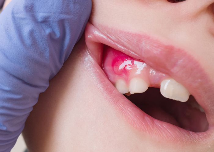 Periodontal Abscess Encinitas