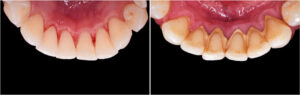 Periodontal Disease Causes Encinitas