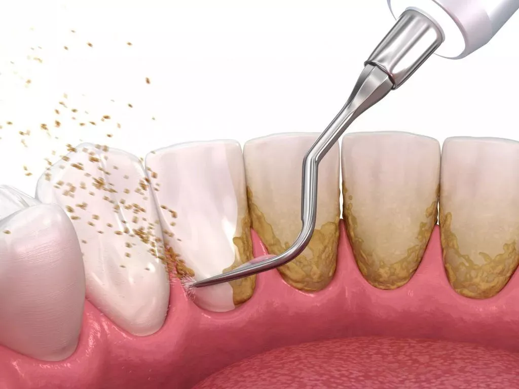 Periodontal Maintenance Encinitas